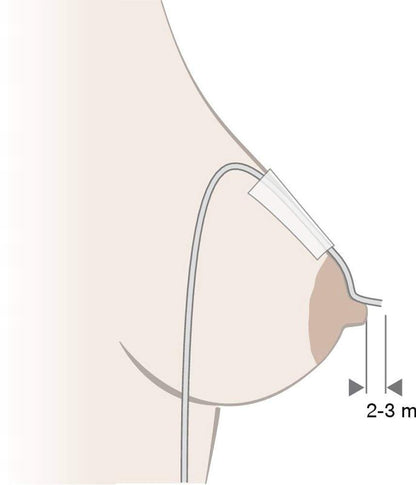 MEDELA system wspomagający karmienie piersią (SNS)